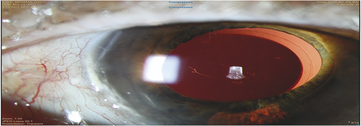 SCLERAL SUTURE FIXATION FOR DISLOCATED SILICONE PLATE HAPTIC INTRAOCULAR LENS