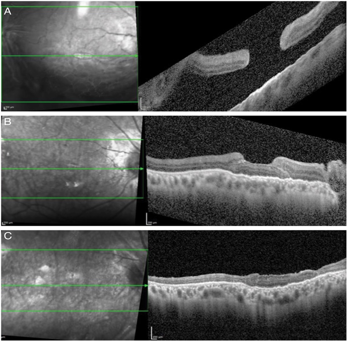 Management of Retinal Detachment With a Coexistent Macular Hole: Submacular Placement of Retinal Autograft Through a Macular Hole