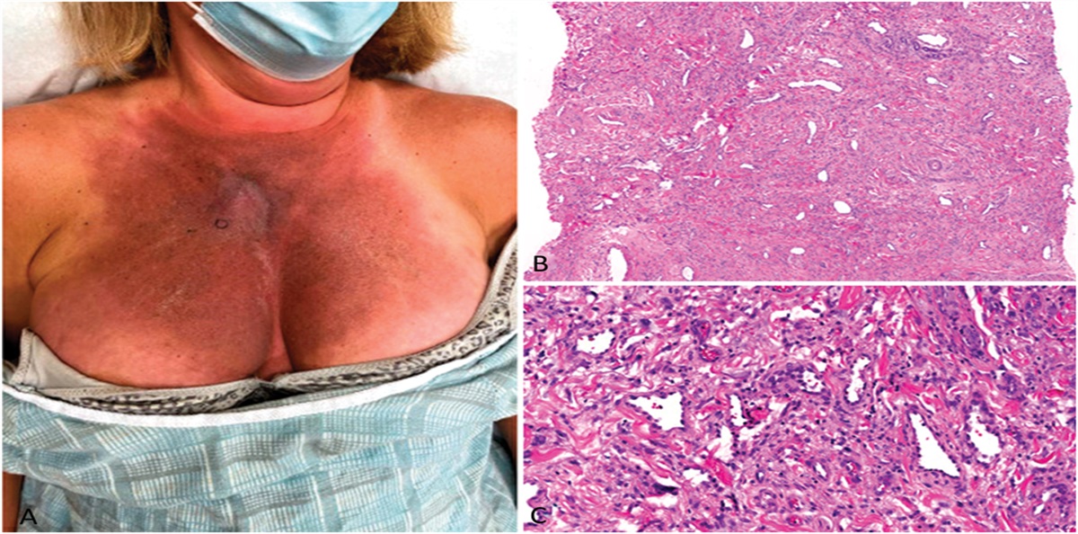 Evolving Chest Plaque: An Intriguing Presentation in a Female Adult With Monoclonal Gammopathy of Unknown Significance (MGUS): Challenge