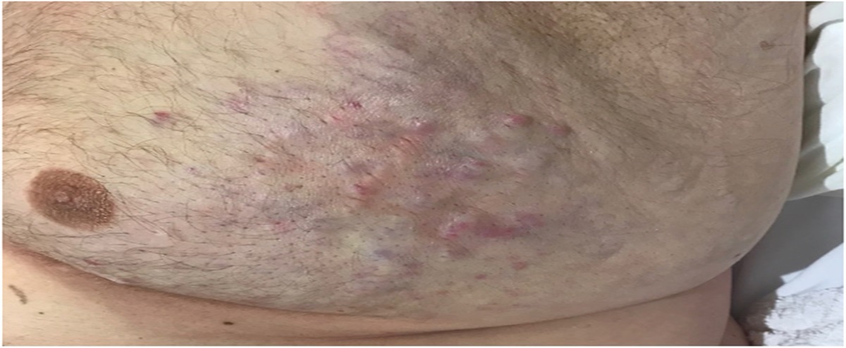 Eruptive Papules as a Cutaneous Manifestation of Metastatic Prostate Adenocarcinoma