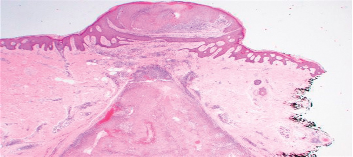 Malignant Melanoacanthoma