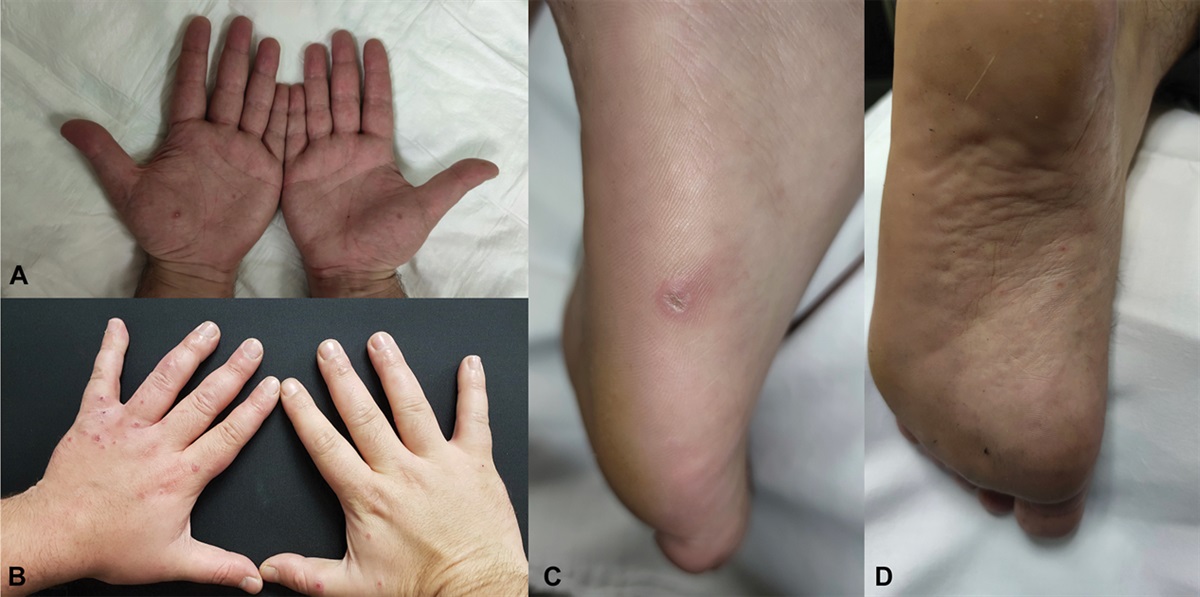 Painful Palmoplantar Lesions Following Vaccination: Challenge