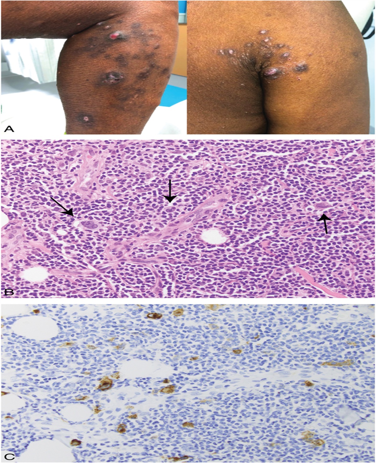 Epstein–Barr Virus–Associated Lymphomatoid Papules: A Sign of Immunosuppression Resembling Lymphomatoid Papulosis