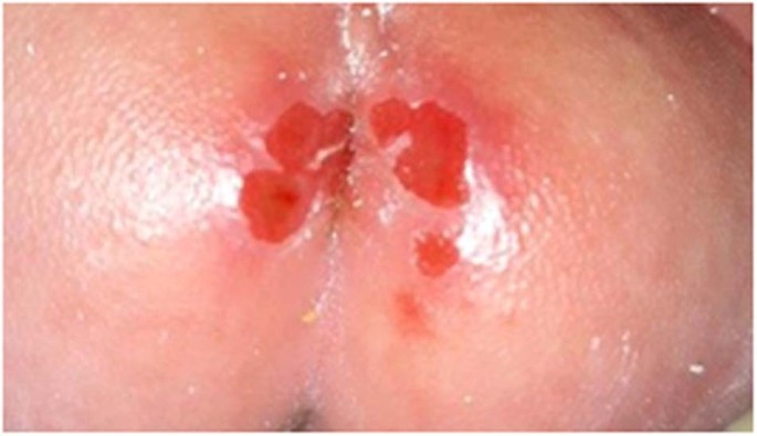 Assessment of diaper dermatitis using a novel electronic health record-embedded scale