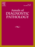 Granulomatous lobular mastitis co-existing with ductal carcinoma in situ: Report of three cases and review of the literature