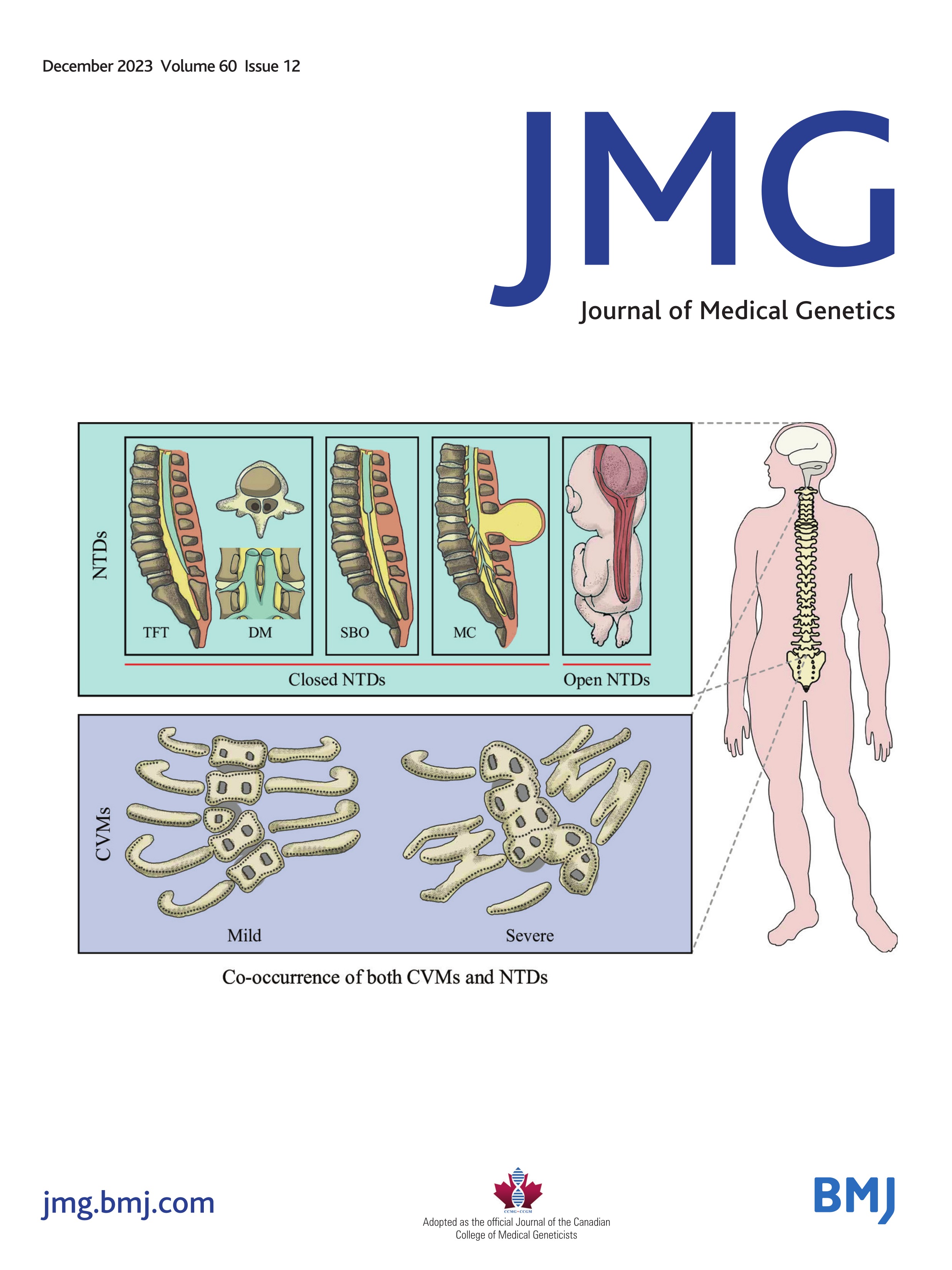Ureteropelvic junction obstruction with primary lymphoedema associated with CELSR1 variants