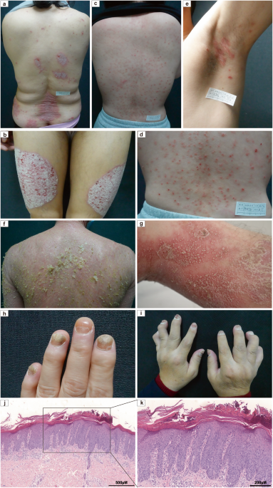 Signaling pathways and targeted therapies for psoriasis