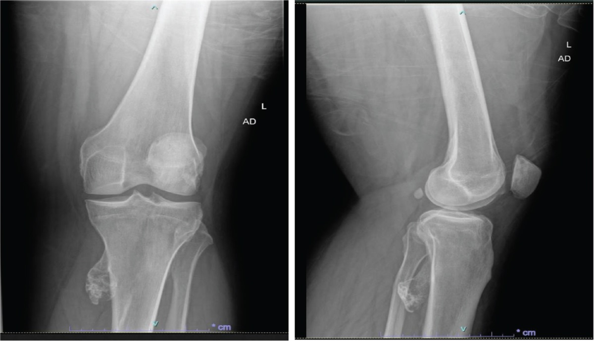 Osteochondroma of Tibia