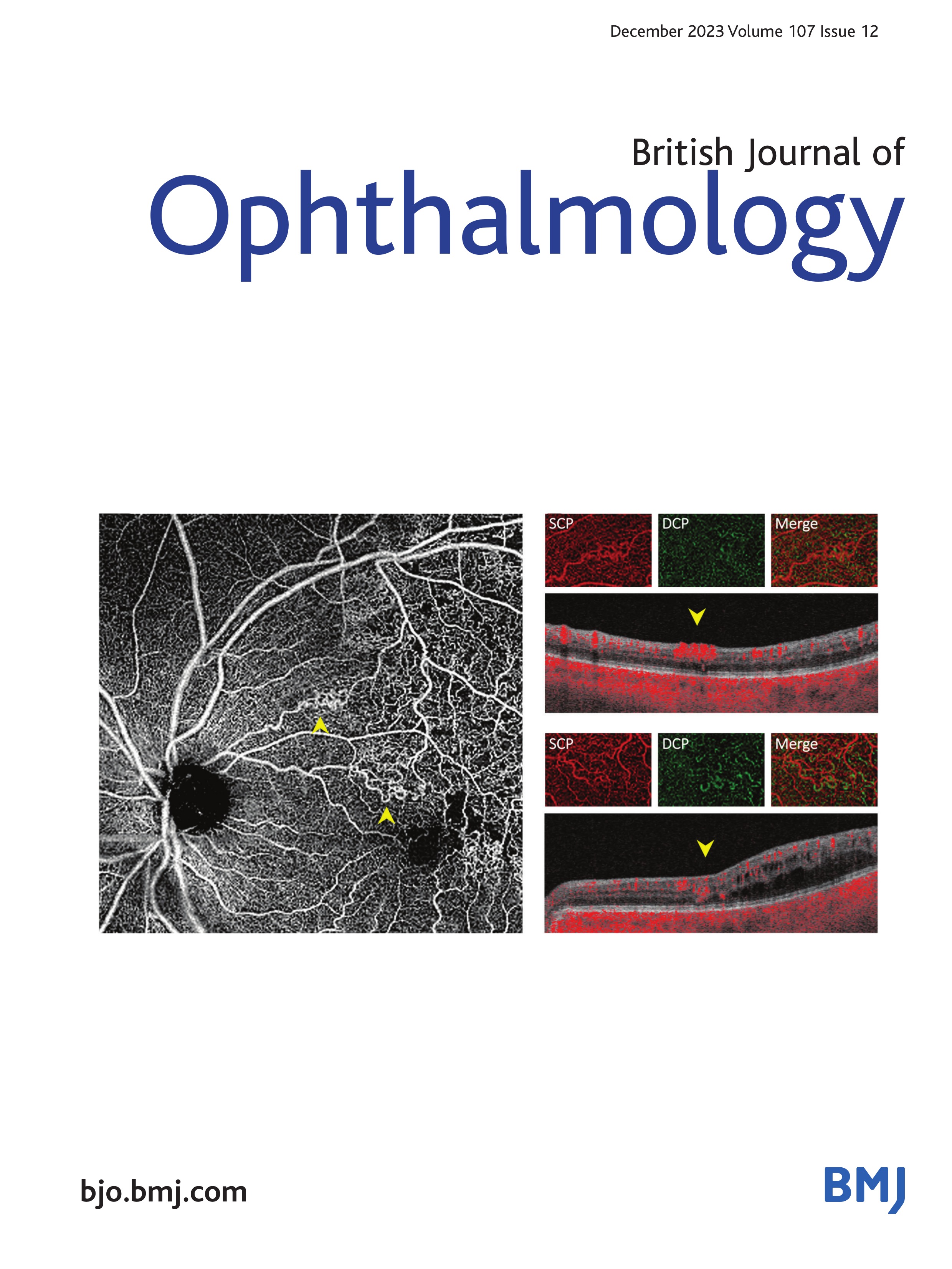 Effect of spectacle lenses with aspherical lenslets on choroidal thickness in myopic children: a 2-year randomised clinical trial