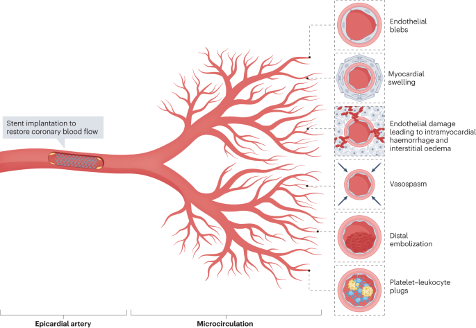 Coronary microvascular obstruction and dysfunction in patients with acute myocardial infarction