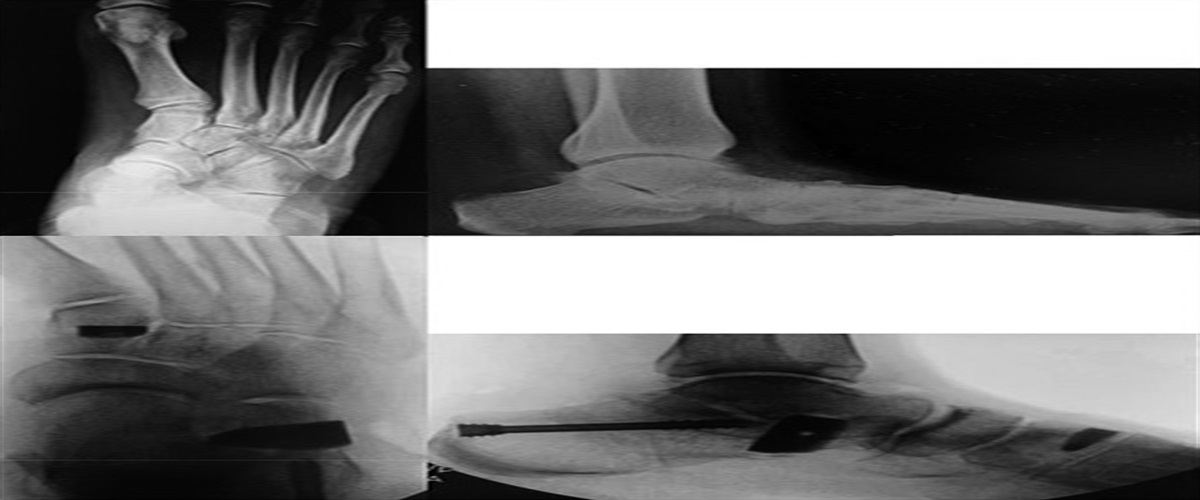 The Mini Bone Extra-articular Reconstruction System for Progressive Collapsing Foot Deformity—Surgical Technique With Cadaveric Quantification of Surrounding Anatomy