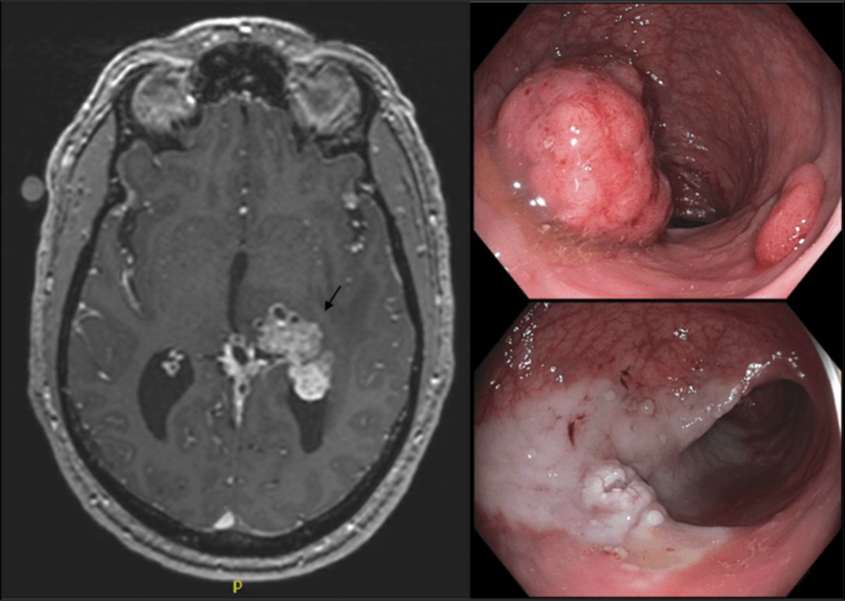 A Rare Case of Metastatic Rectal Cancer to the Brain Presenting with Headaches and Memory Difficulties