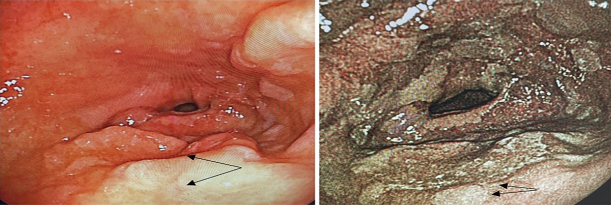 Absence of the Nonextension Sign as a Marker for Endoscopic Submucosal Dissection Suitability