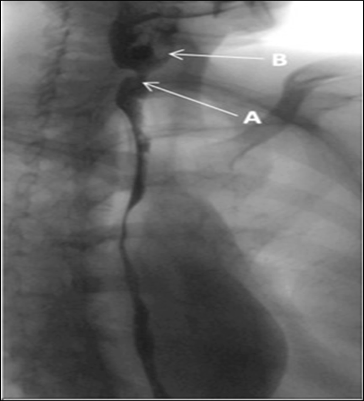 An Unusual Disease With a Common Presentation: Cricopharyngeal Dysfunction in Inclusion Body Myositis