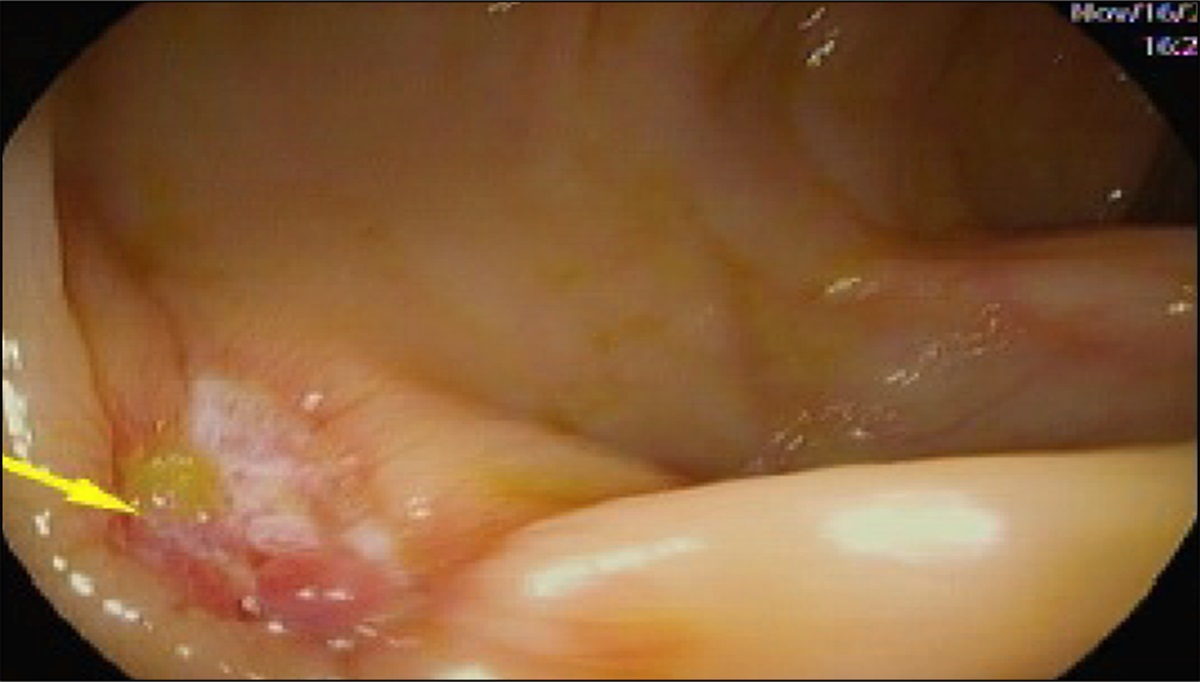 Severe Lupus Enteritis Complicated by Intractable Gastrointestinal Hemorrhage