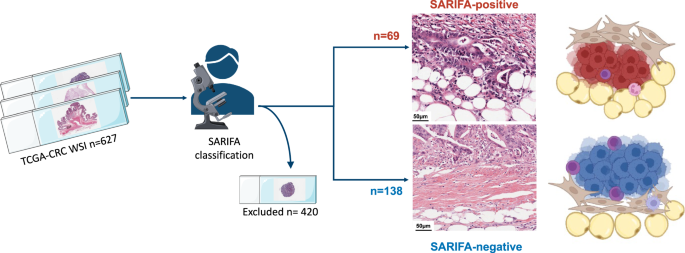 Novel biomarker SARIFA in colorectal cancer: highly prognostic, not genetically driven and histologic indicator of a distinct tumor biology