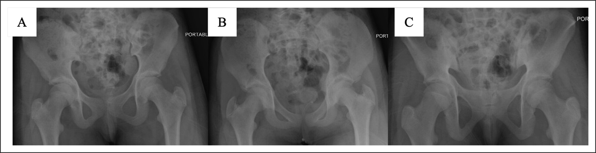 Triangular Osteosynthesis as a Treatment of Lumbopelvic Dissociation with Acute Cauda Equina Syndrome in an 11-Year-Old Patient