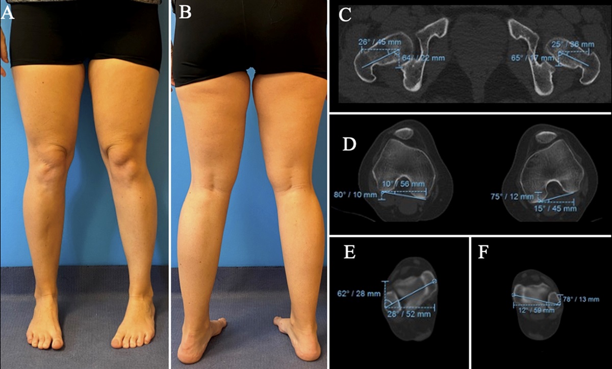 Signficant Femoral Version Abnormalities and Patient-Reported Quality of Life