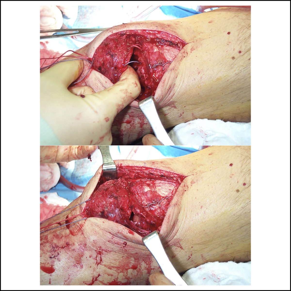 Simultaneous Bilateral Quadriceps Tendon Rupture Secondary to Parathyroid Carcinoma: A Case Report