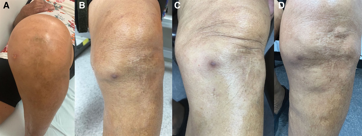 Diagnosis and Treatment of Post-Radiofrequency Synovial Knee Fistula: Case Report