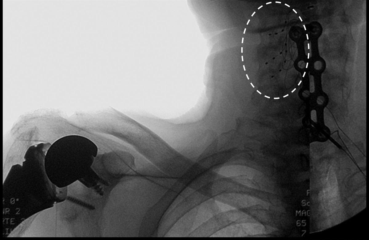 Dorsal Root Ganglion Stimulation to Treat Chronic Shoulder Pain: A Case Report