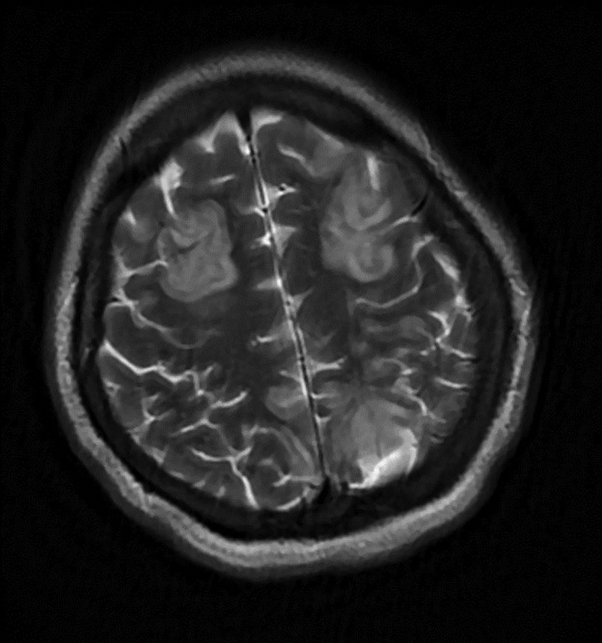 Posterior Reversible Encephalopathy Syndrome and Eclampsia in the Setting of Magnesium Toxicity: A Case Report