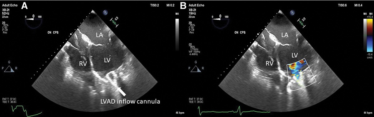 Rare Case of Interventricular Septal Hematoma After Left Ventricular Assist Device Implantation: Role of Transesophageal Echocardiogram in Diagnosis and Management