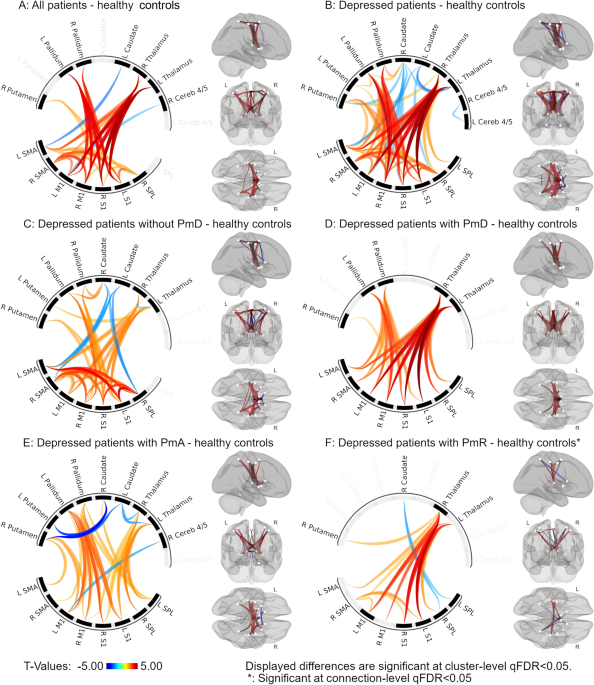 The neural signature of psychomotor disturbance in depression