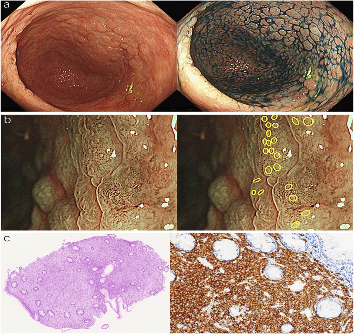 Systemic Mastocytosis Observed by Image-Enhanced Endoscopy