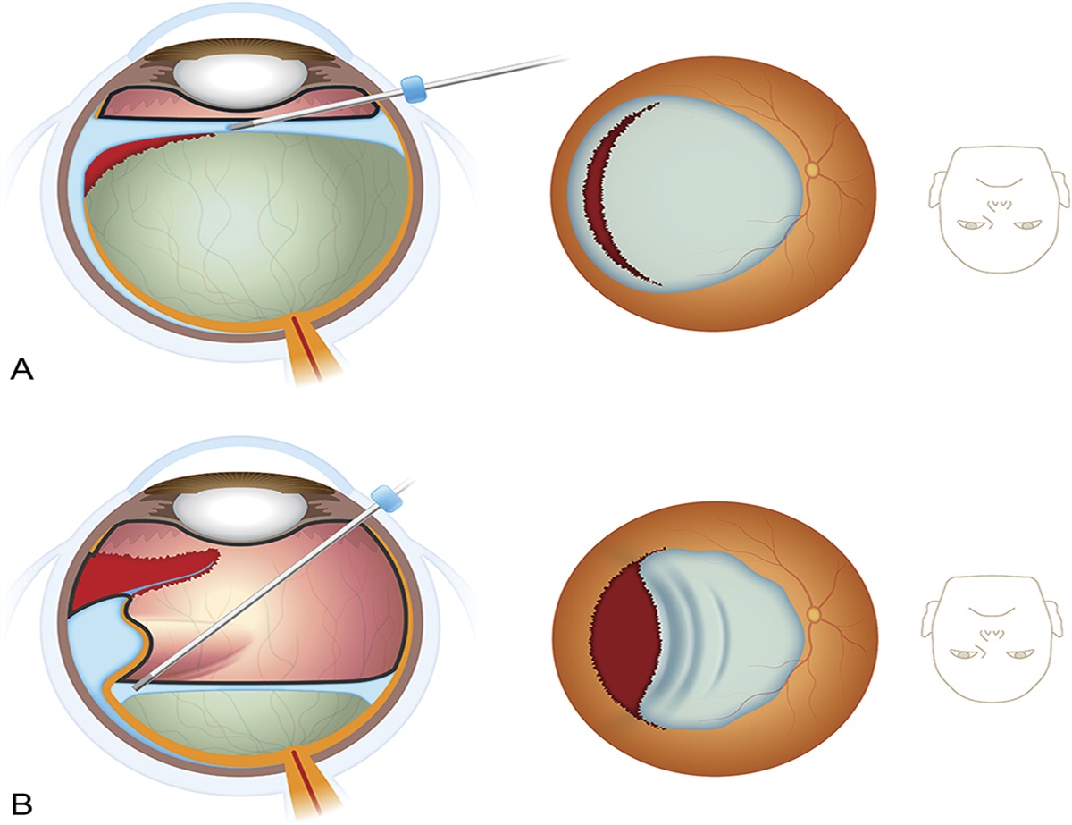 Head-Tilt Perfluorocarbon–Air Exchange Technique With Heads-Up Surgery for Giant Retinal Tear-Associated Retinal Detachments to Prevent Retinal Slippage Without Using Silicone Oil