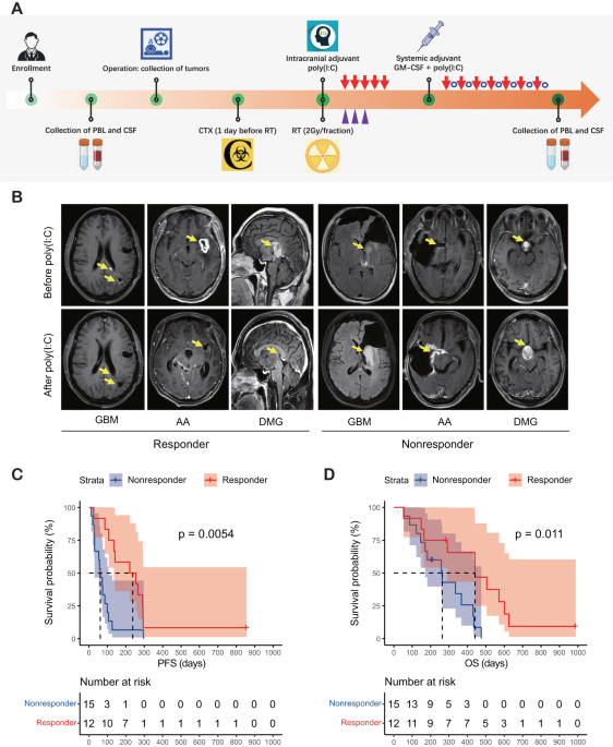 Glioma-derived ANXA1 suppresses the immune response to TLR3 ligands by promoting an anti-inflammatory tumor microenvironment